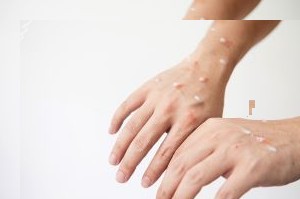 Hasil Labor Kemenkes, 2 Warga Kepulauan Meranti Negatif Virus Cacar Monyet